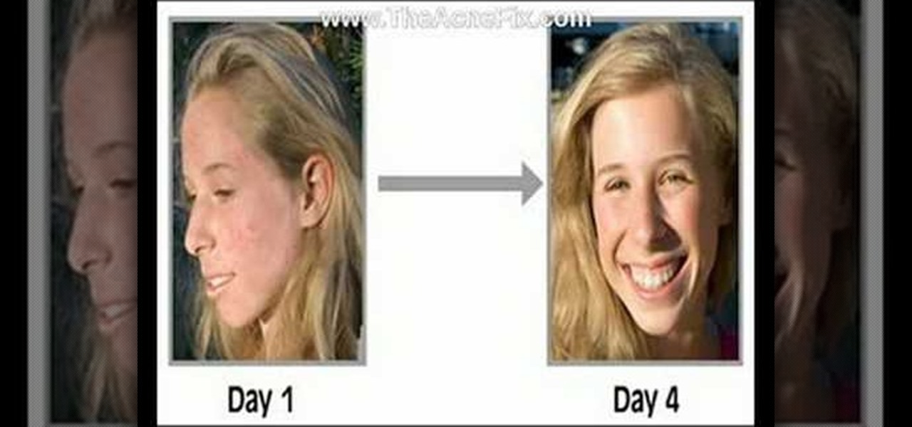 Acne Free In 3 Days Get Rid Of Acne Pimples Natural | Search Results ...