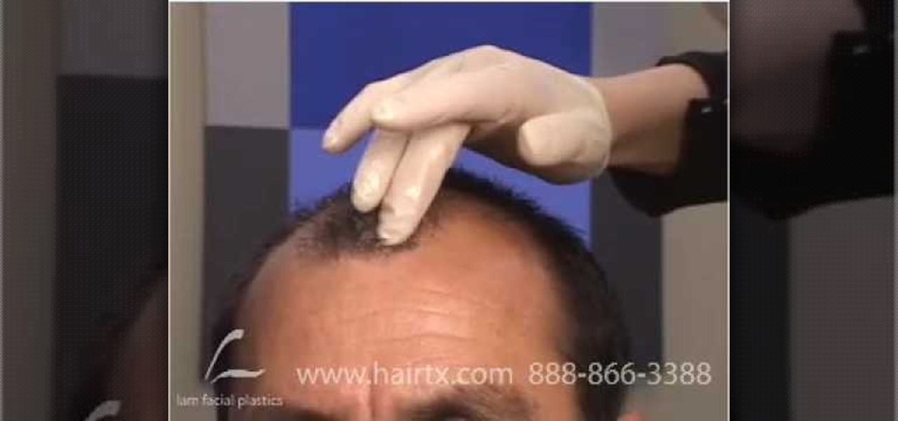 How to Remove scabs after a hair transplant a comb « Medical Diagnosis &  Procedures :: WonderHowTo