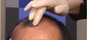Remove scabs after a hair transplant a comb