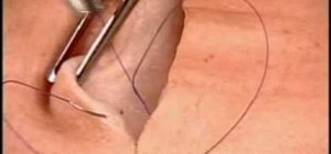 Use subdermal interrupted suturing on a patient