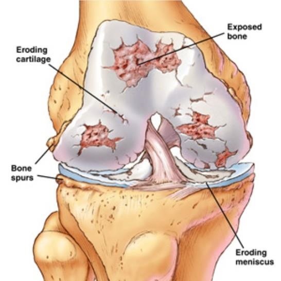 How Could Stem Cell Treat Osteoarthritis