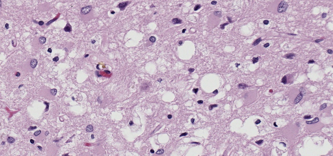 We've Finally Developed a Test for Mysterious Prion Diseases— Parkinson's & Alzheimer's Could Be Next