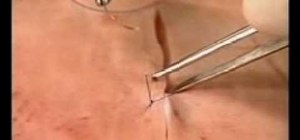 Perform a vertical mattress suture during surgery
