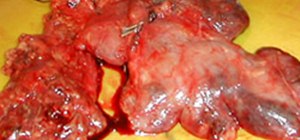 Cut Out the Thymus Gland with 3 Different Thymectomy Procedures