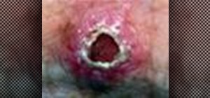 Identify the skin disease squamous cell carcinoma