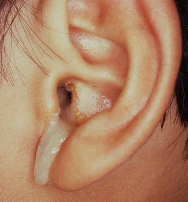 How to Deal with Ear Discharge