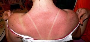Treat a sunburn properly