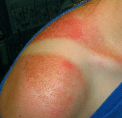 How to Get Rid of a Sunburn (The Single Most Effective Method)