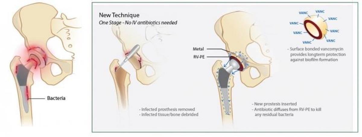 Replacement Joints with Antibiotics on Board Mean Lower Chance of Infection & Fewer Surgeries