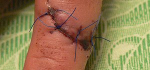 Suture a wound