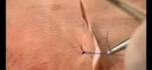 Use a horizontal mattress suture on a wound