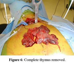 How to Cut Out the Thymus Gland with 3 Different Thymectomy Procedures