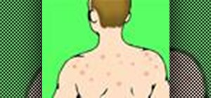 Get rid of bacne back acne