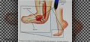 Treat a sports injury of turf toe
