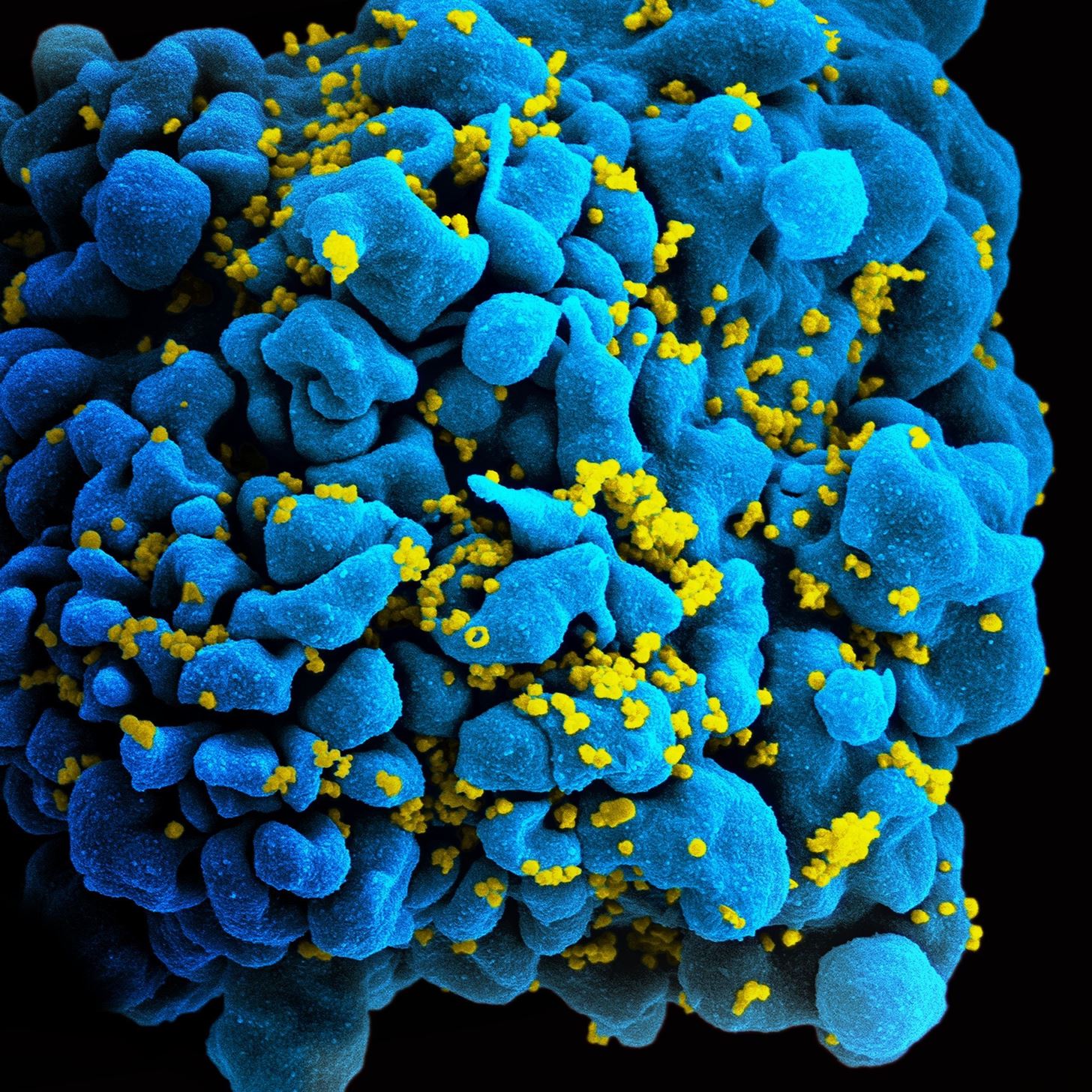 The Body's Own Cells Can Be Engineered to Protect Against HIV Infection