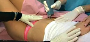 Remove stretch marks with lasers