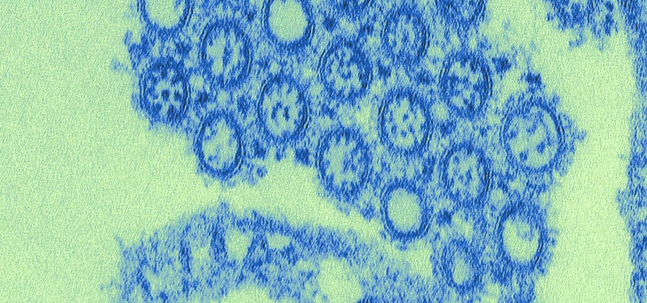 Swine Flu Linked to Parkinson's Like Brain Changes