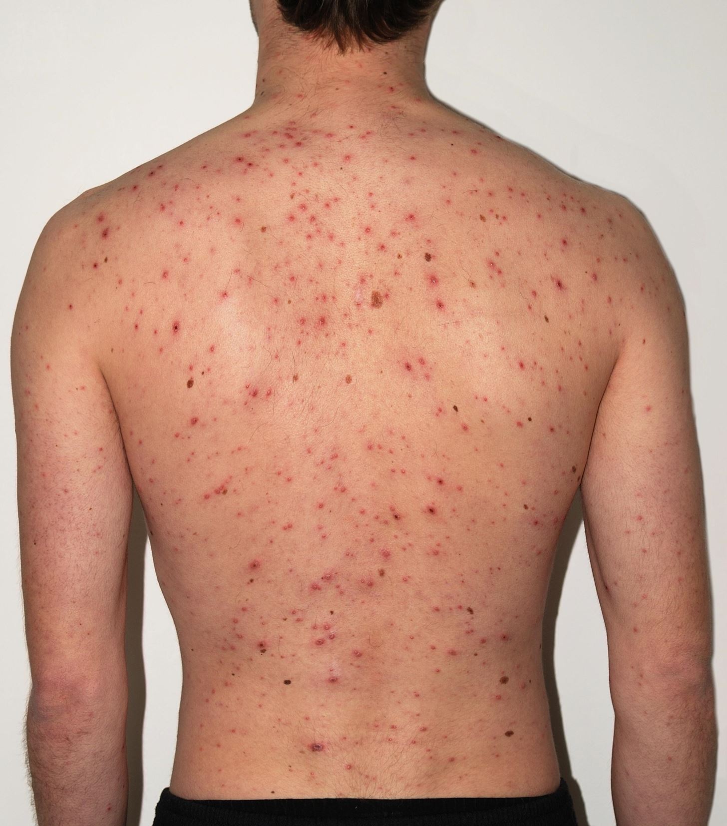 if you're getting shingles flare-ups under 40, get your heart
