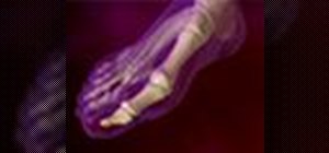 Diagnose and treat bunions