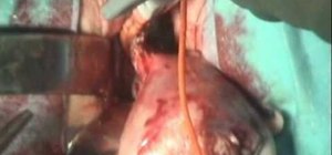 Perform a vaginal hysterectomy