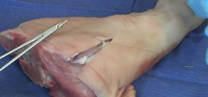 Perform a subcutaneous suture on a patient