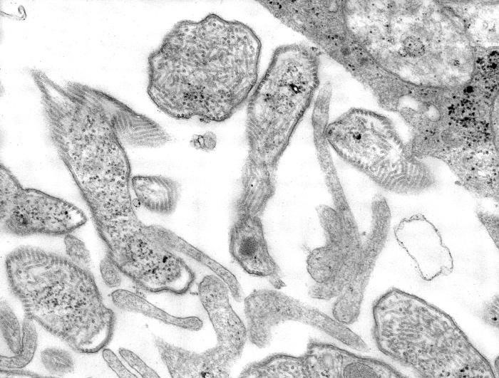 Worrisome Outbreak of Mumps Spreads in Colorado