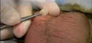 Perform a vasectomy without a scalpel