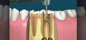 Understand the procedure for root canals