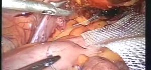 Perform a laparoscopic suture in surgery