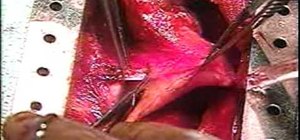 Remove the hyperplastic thymus gland with a thymectomy for myasthenia gravis