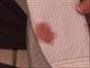 Remove blood stains from clothes