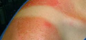 Get Rid of a Sunburn (The Single Most Effective Method)