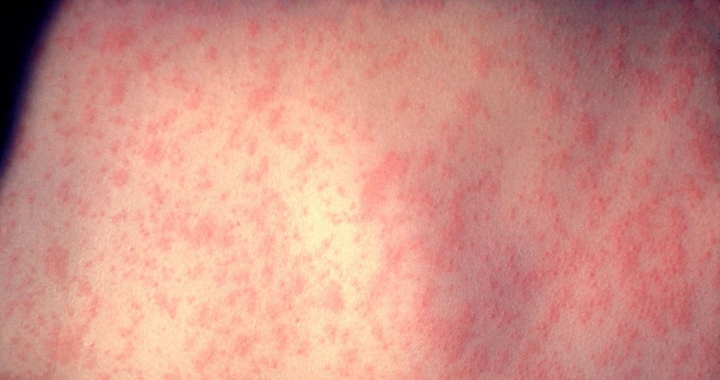 Maine Just Got Their First Case of Measles in 20 Years