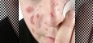 Treat severe acne