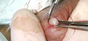 Perform an In-Line vasectomy